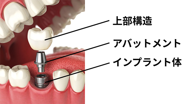 インプラントの構造