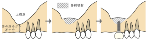 ソケットリフト