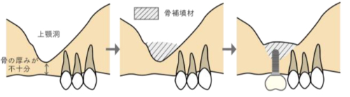 サイナスリフト