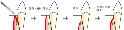 険適応外歯周外科01