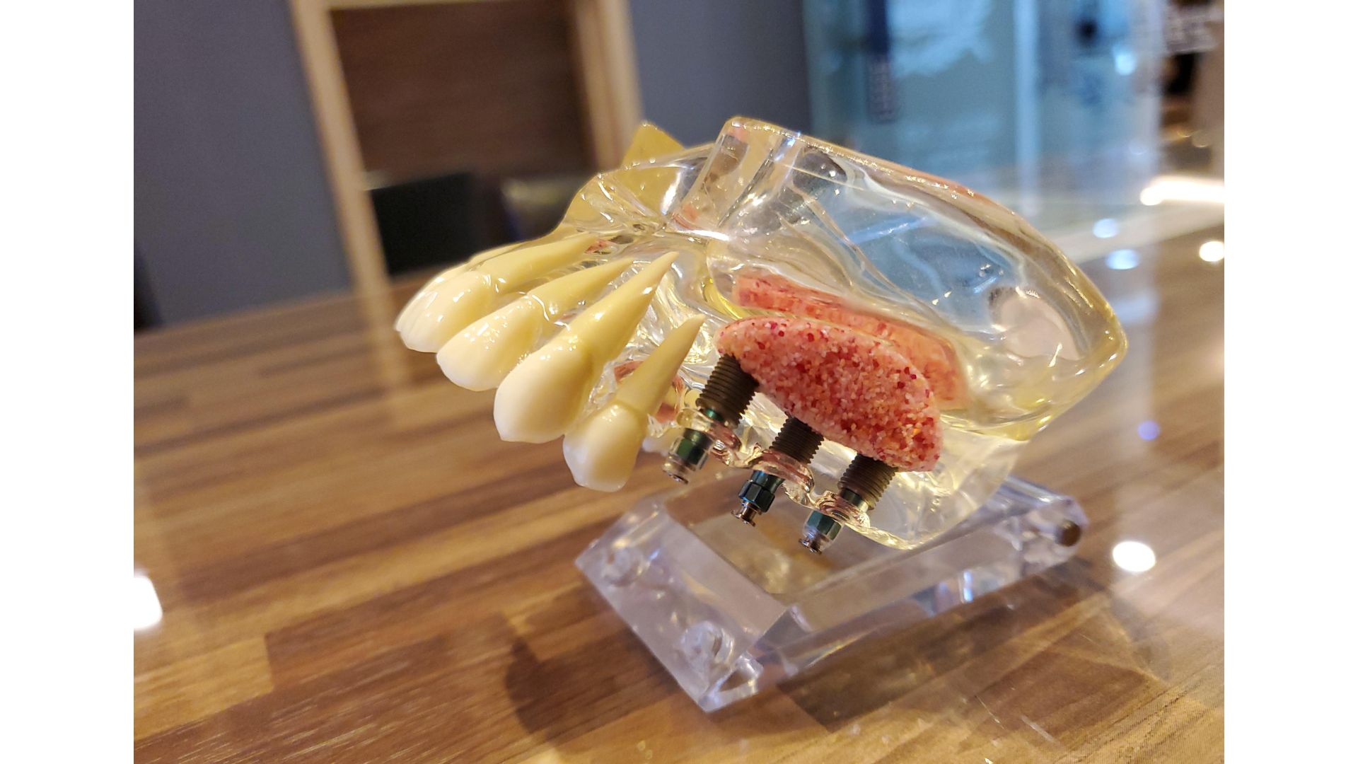 インプラント治療に必要な骨造成とは？骨が足りない方への安心ガイド