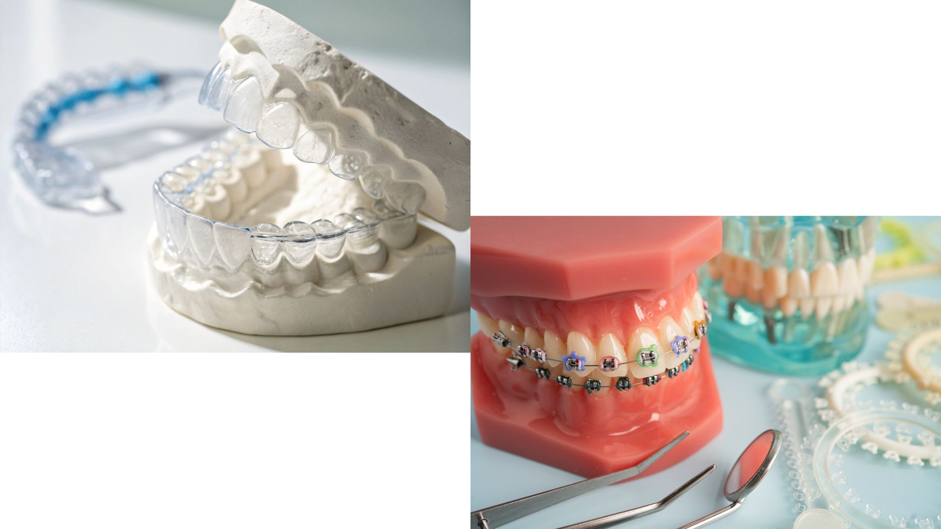 【どっちが痛い？】ワイヤー矯正とマウスピース矯正の痛みの違い｜博多駅5分の歯医者が解説