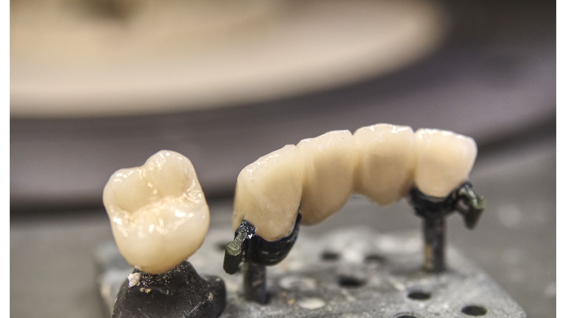 【どっちがいい？】保険のCAD冠と自費セラミックの違い｜博多の歯医者が徹底解説