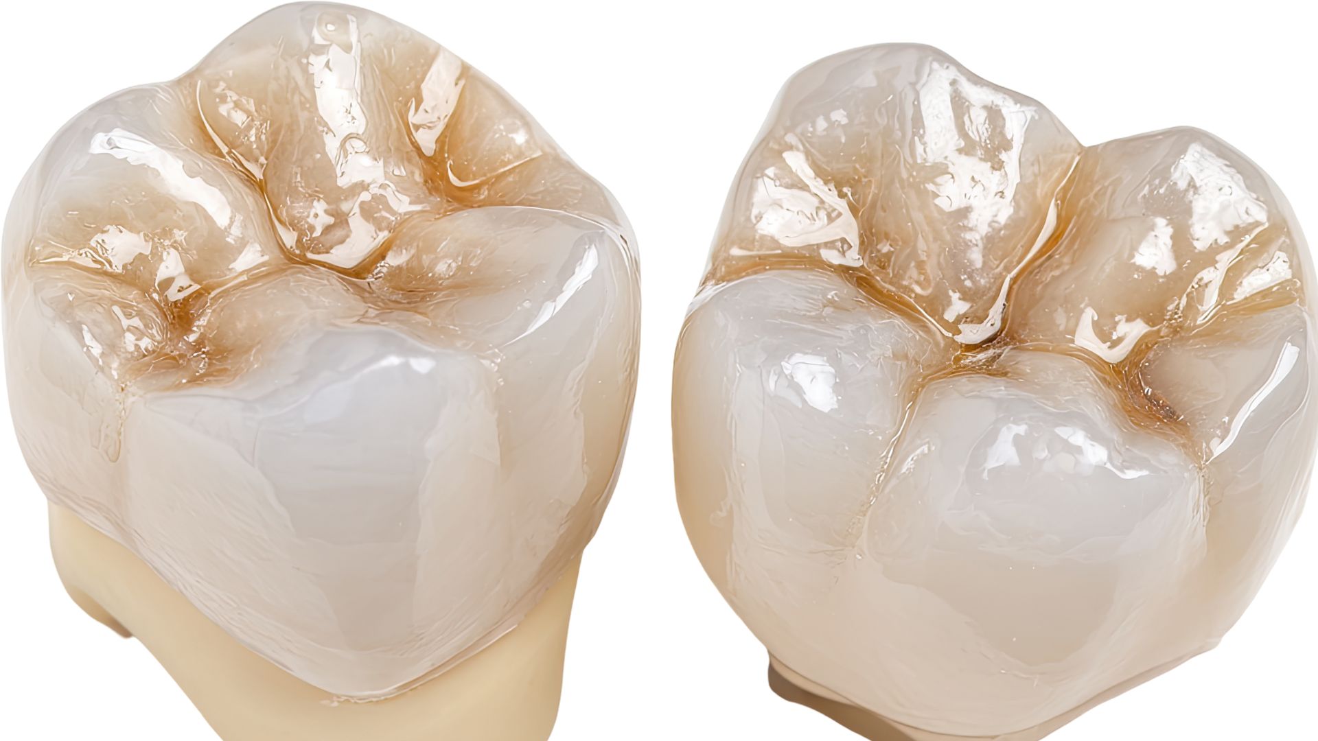 【保険でできる白い詰め物】コンポジットレジンの適応と治療のポイント｜福岡・博多