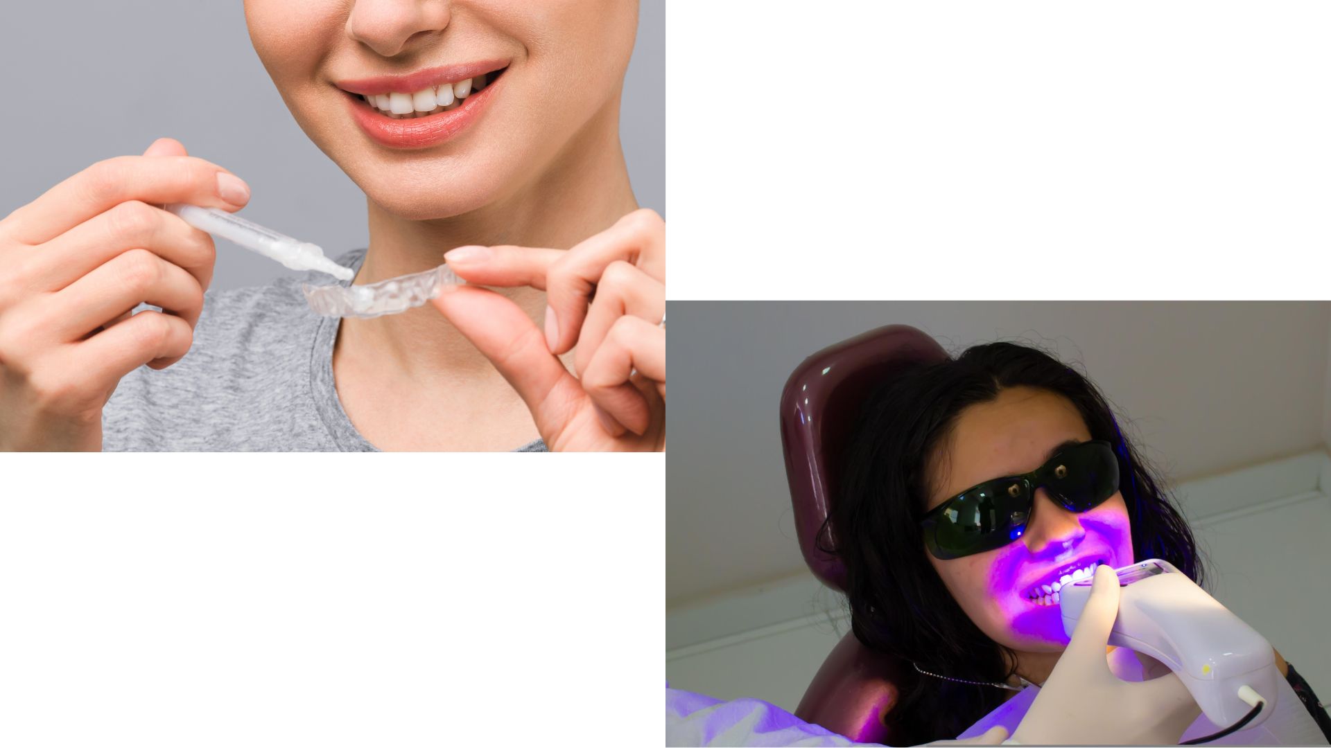 【ホワイトニングの仕組み】なぜ歯が白くなるの？｜福岡・博多