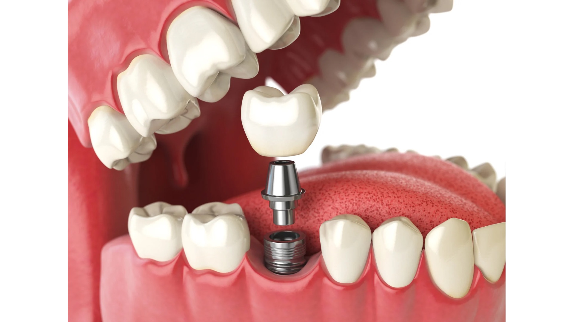 【失った歯の“最有力候補”】インプラントのメリット・デメリットを徹底解説｜博多駅5分