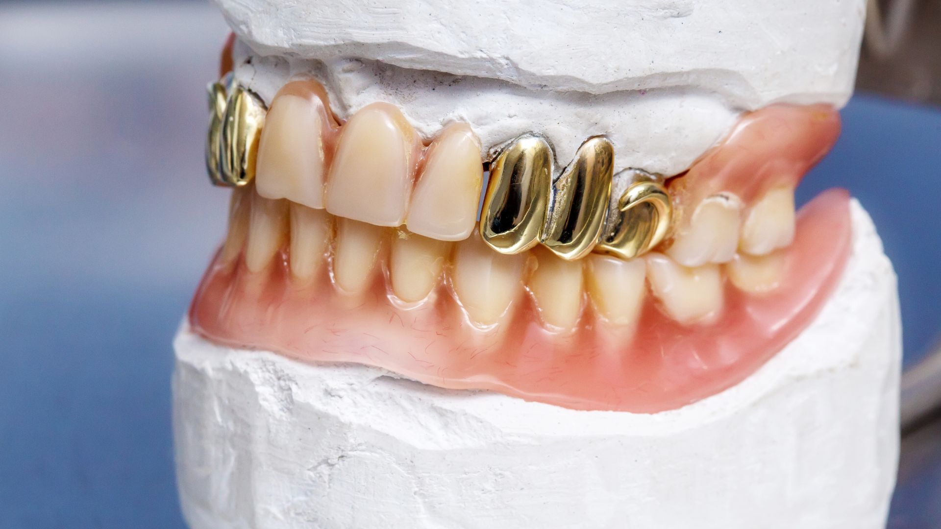 【どっちが正解？】金歯 vs セラミック｜機能性・見た目・長持ちで徹底比較！｜博多駅5分の歯医者が解説