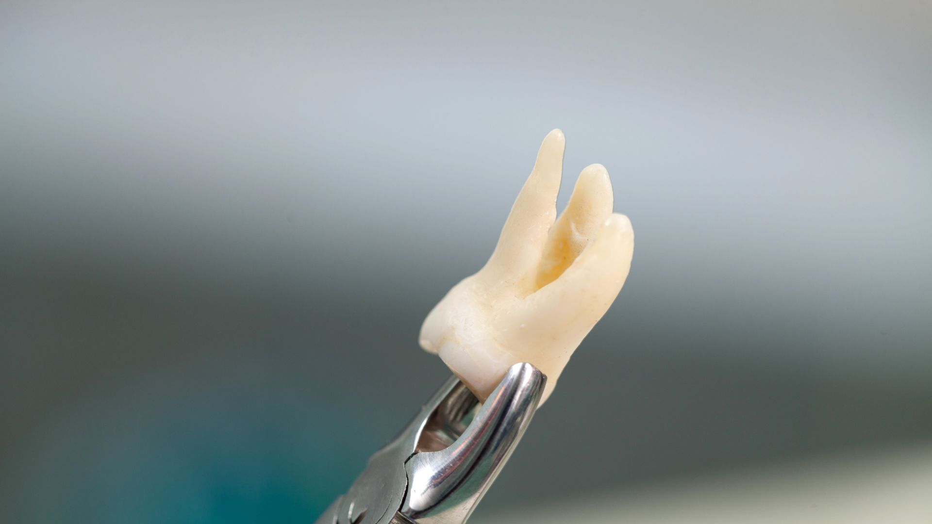 【歯医者が“抜歯です”と言うとき】どんな歯が抜かれるべき状態なのか｜博多駅5分の歯医者が解説