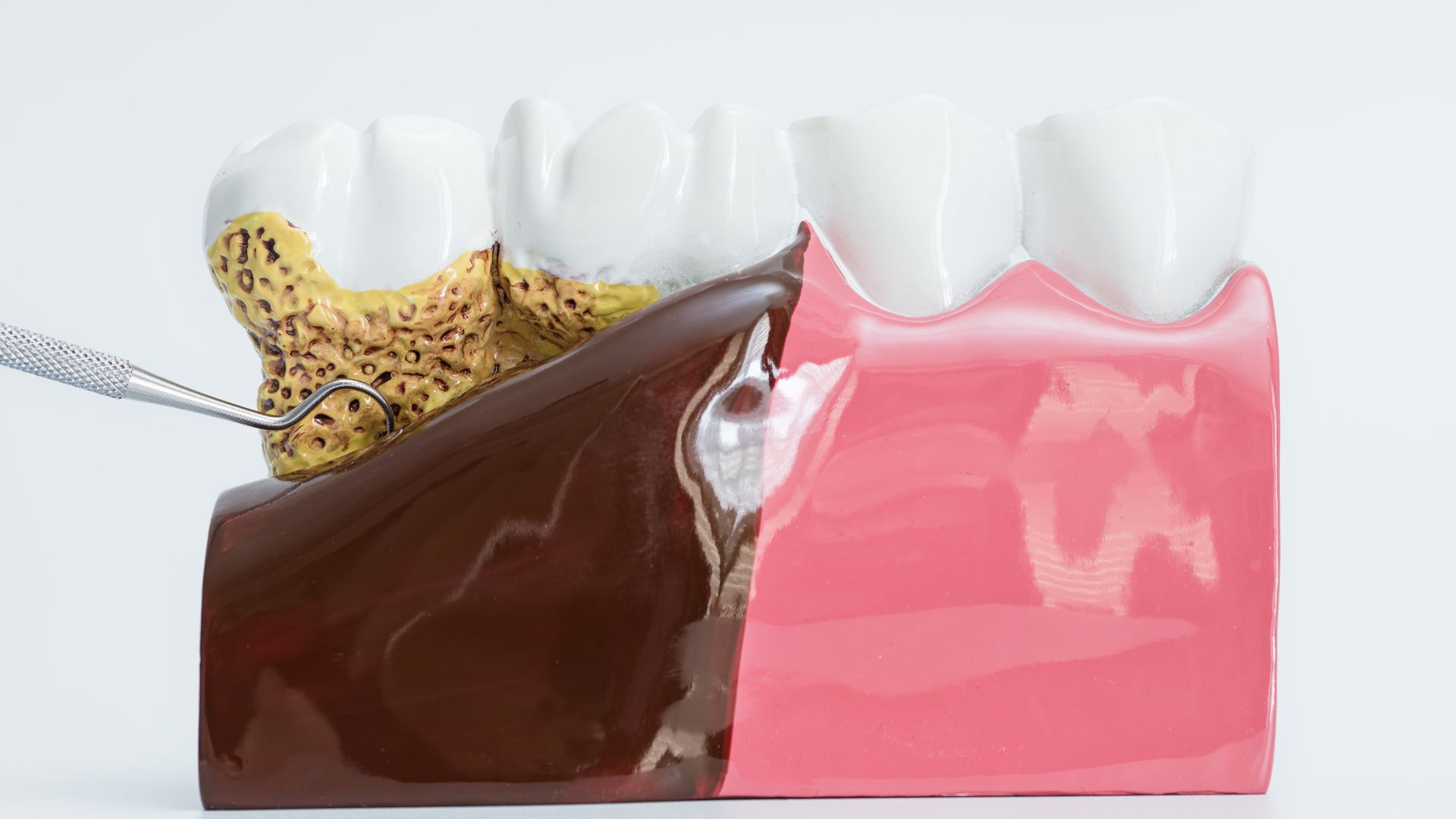 【保険でできる歯周病治療の流れ】初診〜再評価までを徹底解説｜博多駅5分の歯医者が解説