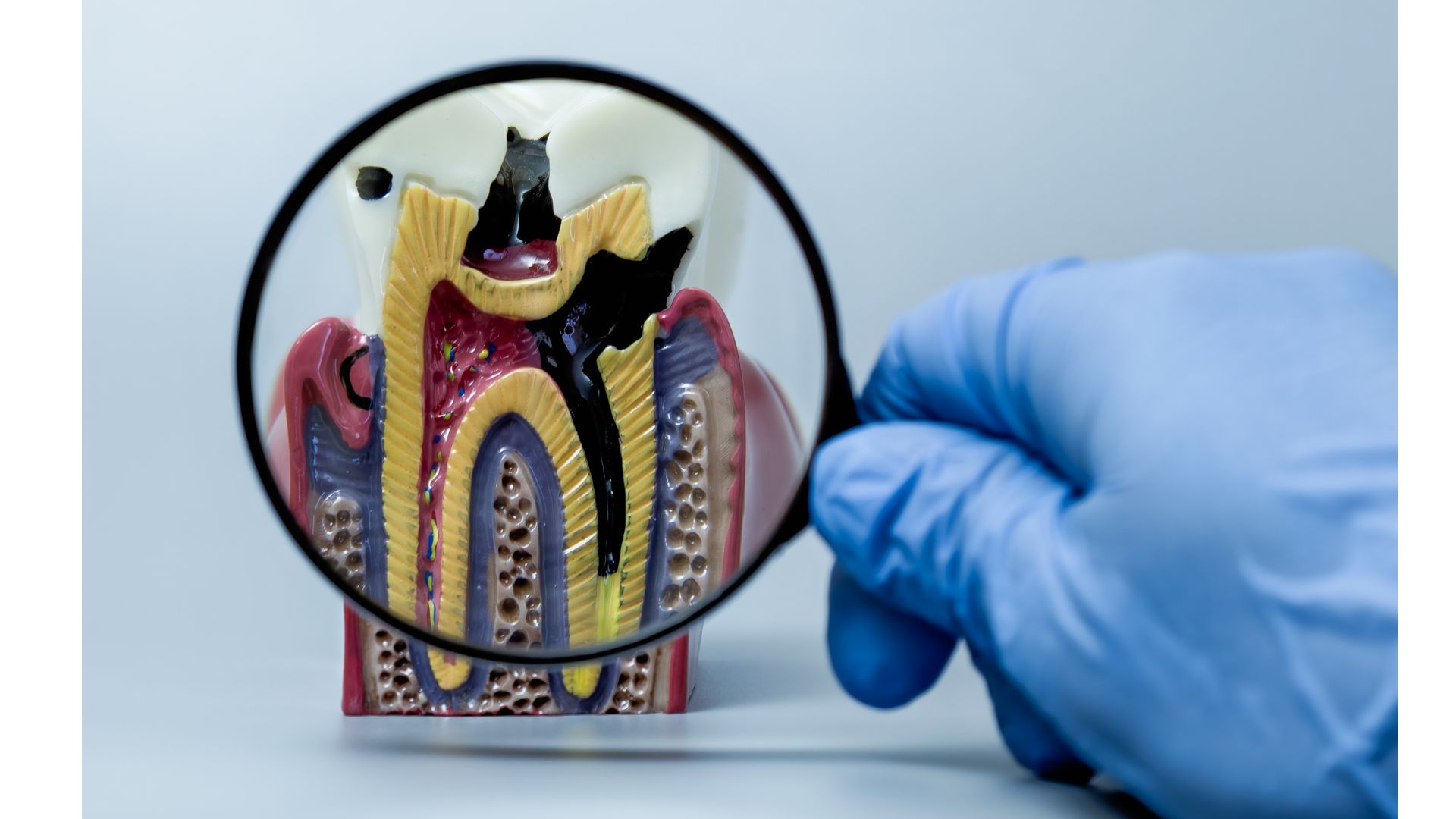 削るべきむし歯、削るべきでないむし歯｜歯医者が判断するときに見ているポイント