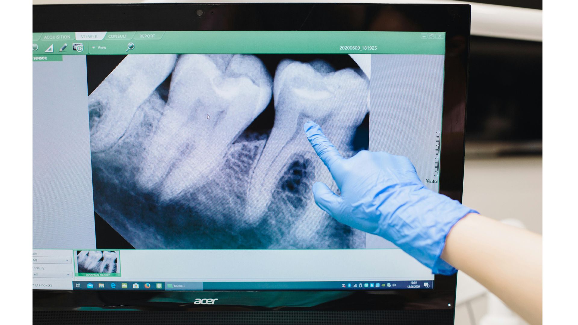 むし歯は歯磨きでは防げない？本当に大切な予防の考え方
