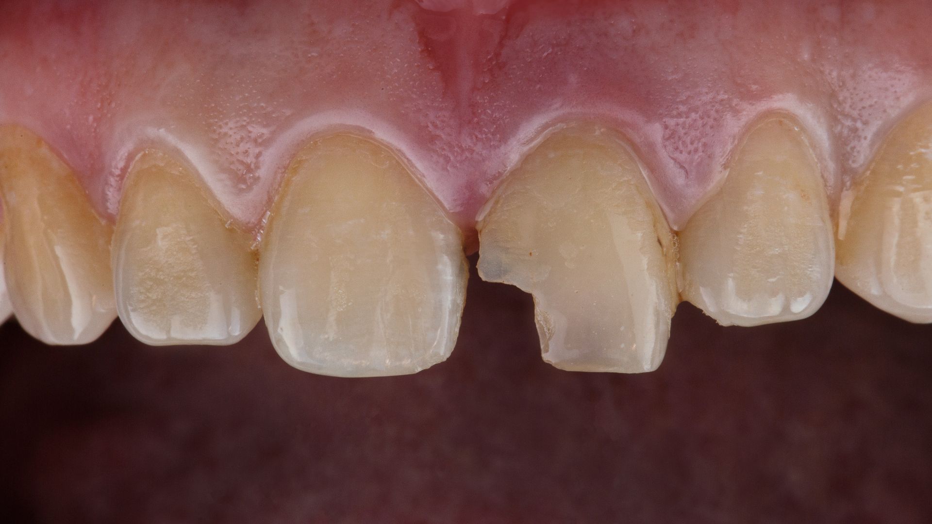 前歯が欠けてしまったらどうしたらいい？慌てずに知っておきたい対処法