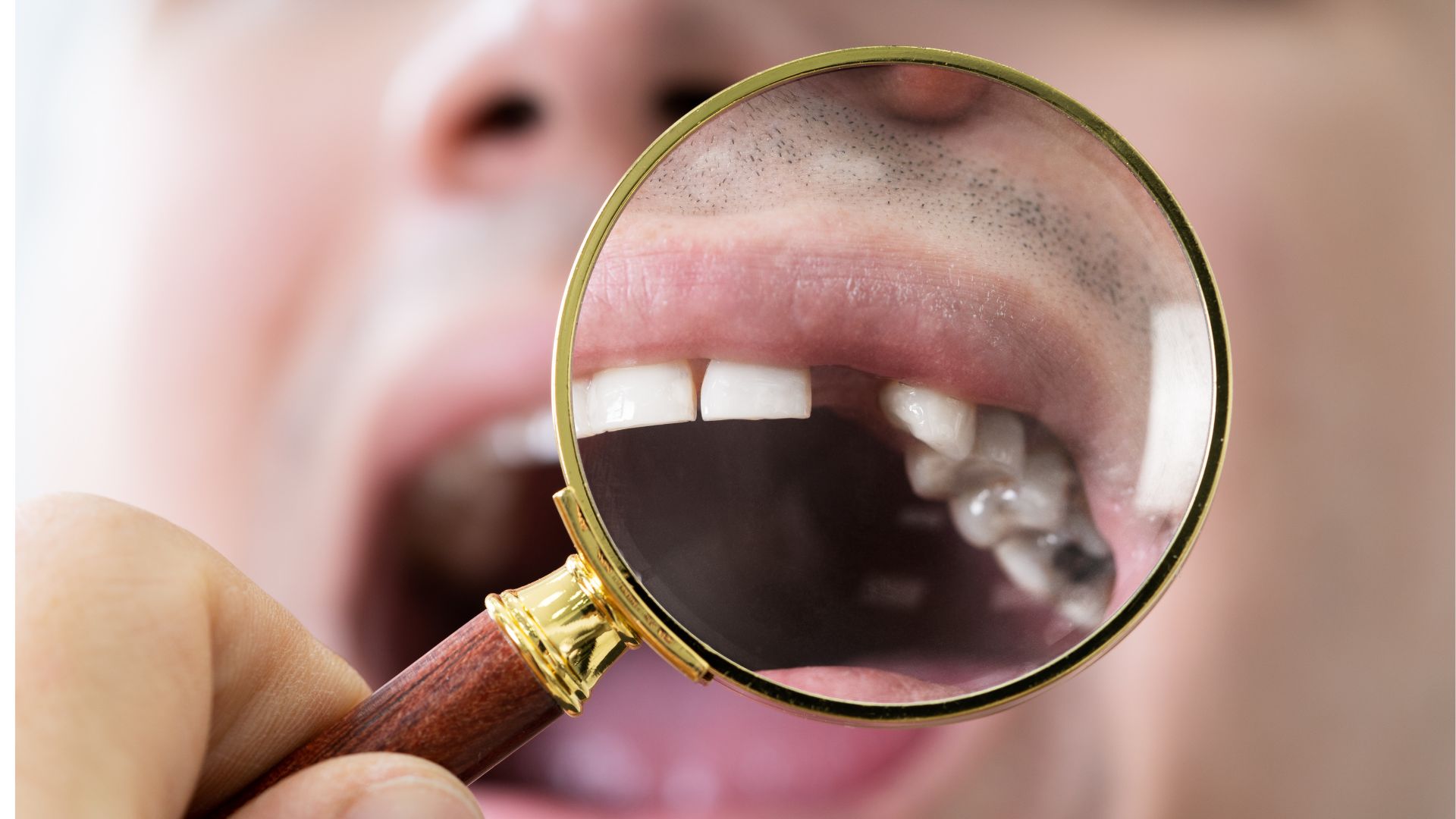 【1本でも放置は危険】歯を失うと起こる7つの変化と将来のリスク｜博多駅5分の歯医者が解説