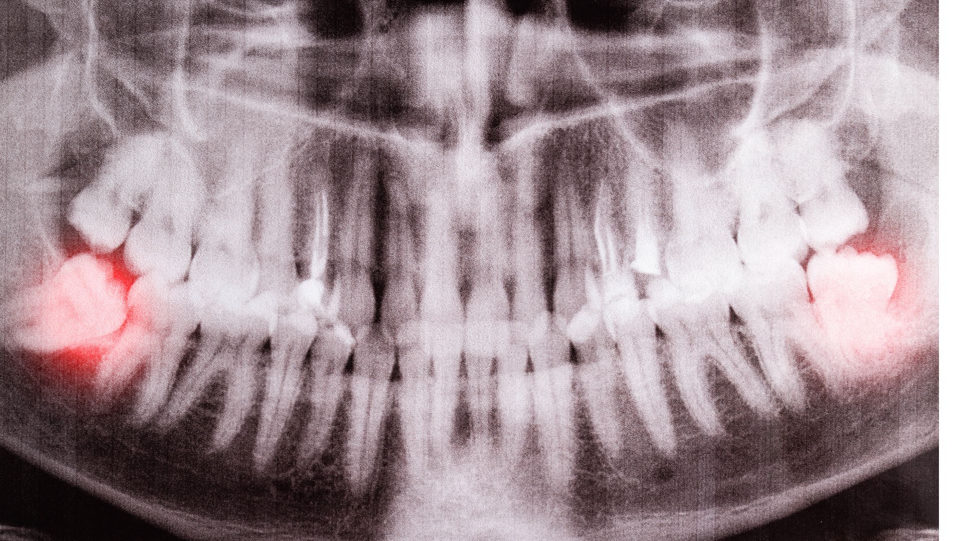 【絶対に守って！】親知らず抜歯後に注意すべき10項目｜博多駅5分・口腔外科認定医在籍の歯科医院が解説