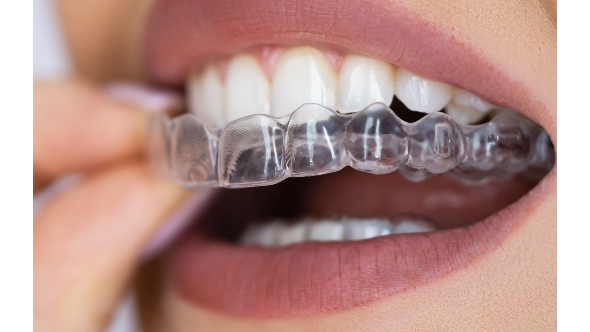 【長持ち＆清潔がポイント】ナイトガード（マウスピース）のお手入れ方法｜博多駅5分の歯医者が解説