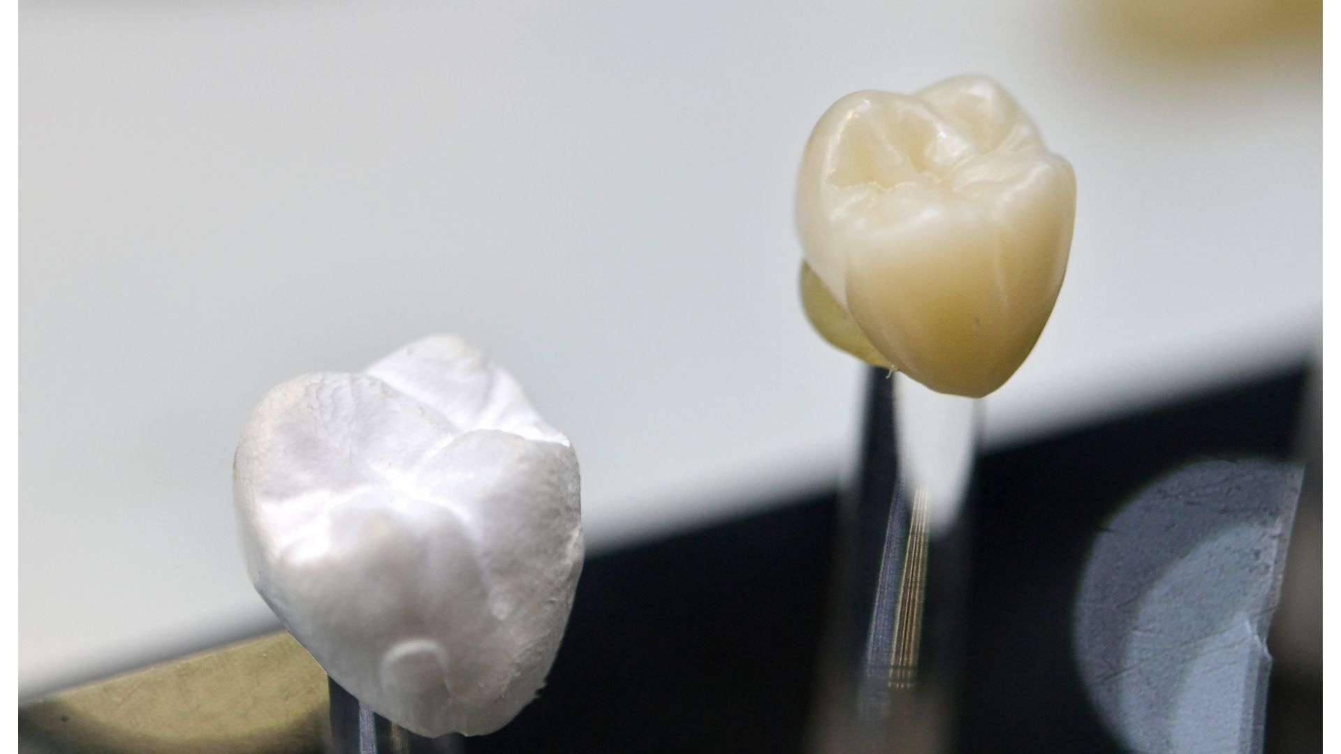 【なぜこんなに違う？】セラミック治療が保険治療より高い本当の理由｜博多駅5分の歯医者が解説