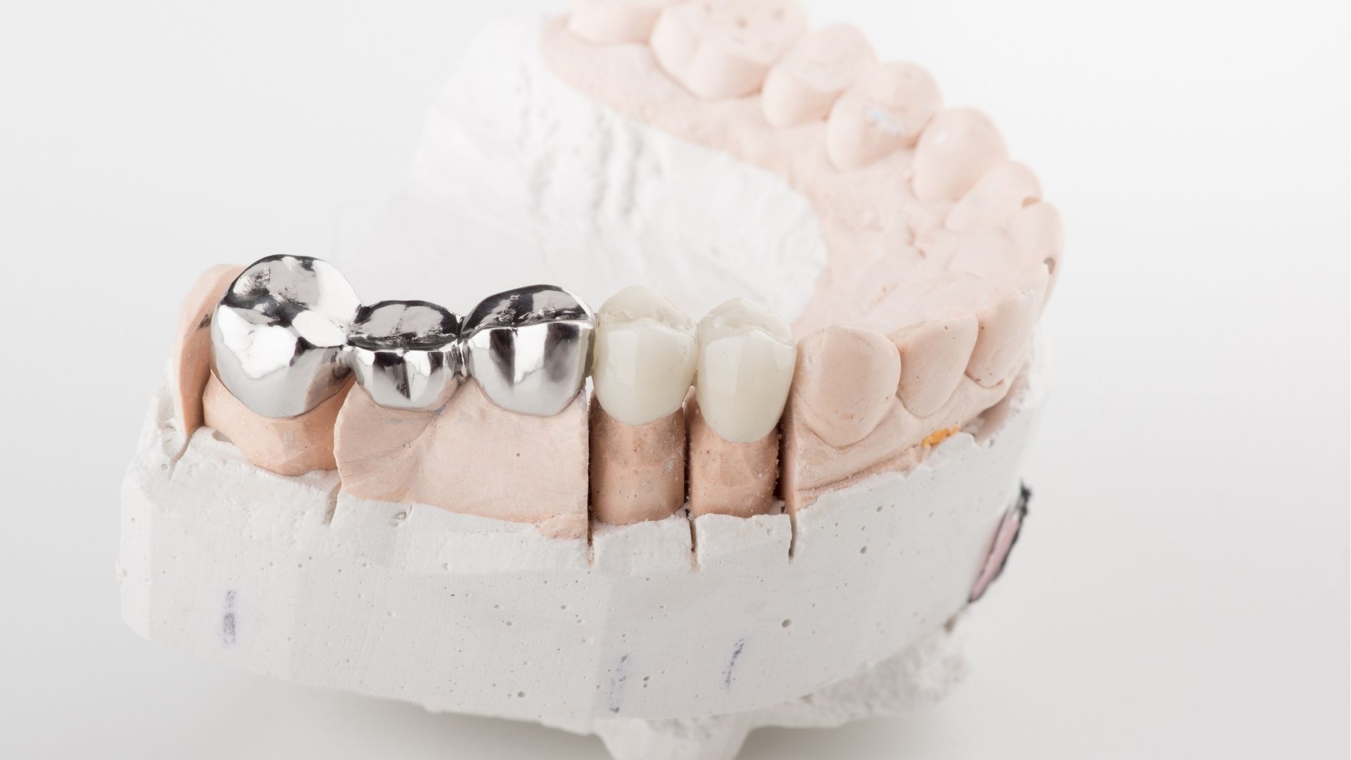 【削る前に知ってほしい】ブリッジのメリットとデメリットを歯科医が本音で解説｜博多駅5分の歯医者