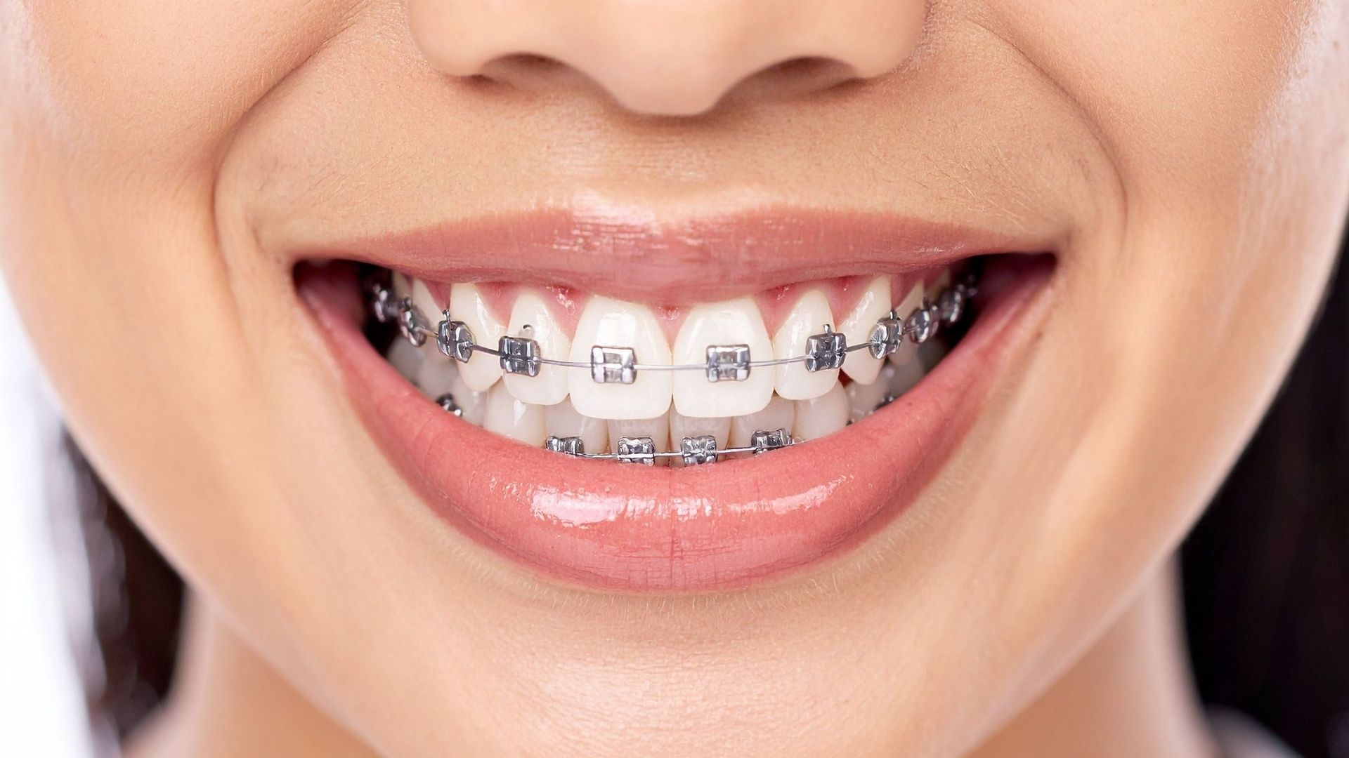 【本当に抜く必要ある？】抜歯矯正のメリットとデメリットを歯科医がわかりやすく解説｜博多駅5分の歯医者