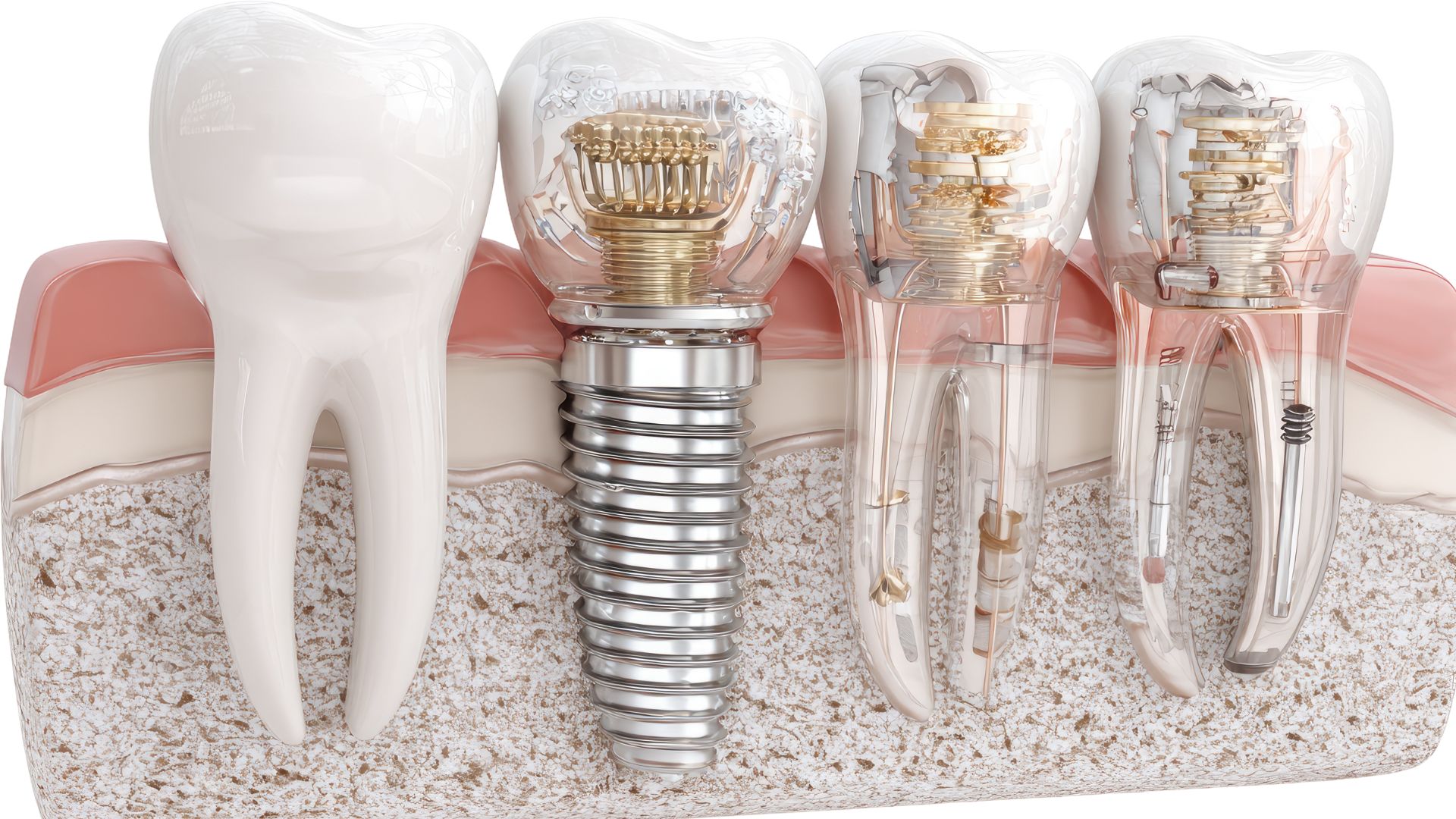 【値段だけで判断しないで】インプラントはなぜ高い？その理由を歯科医が正直に解説｜博多駅5分の歯医者