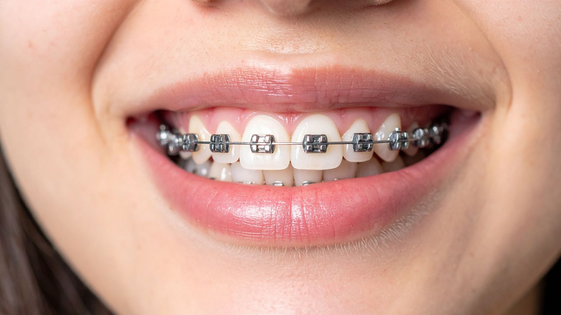 【安さだけで選ばないで】部分矯正を無理して行うときの注意点｜IPRで歯を削りすぎるリスクとは？