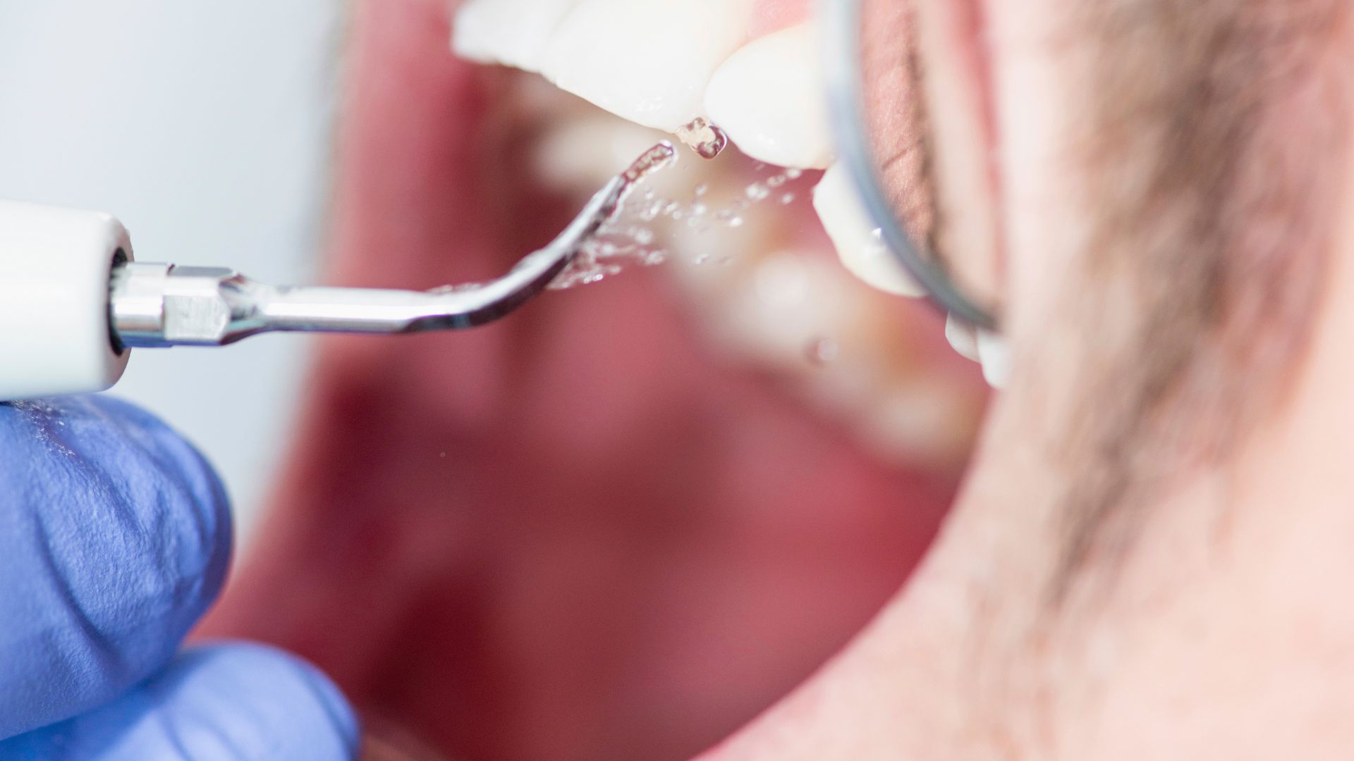 【放置は危険？】歯石は取らないとダメなの？歯科医が本音で解説｜博多駅5分の歯医者