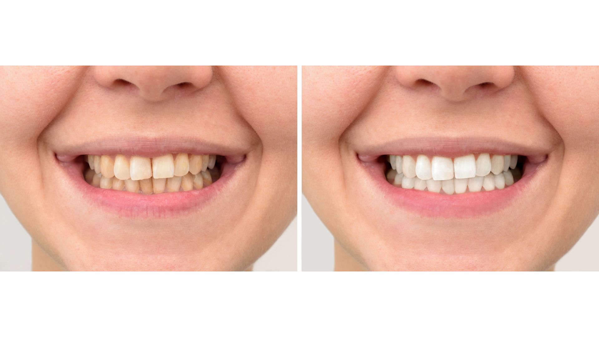 【白くしたい人必見】クリーニングとホワイトニングの違いとは？目的別の正しい選び方｜博多駅5分の歯医者が解説