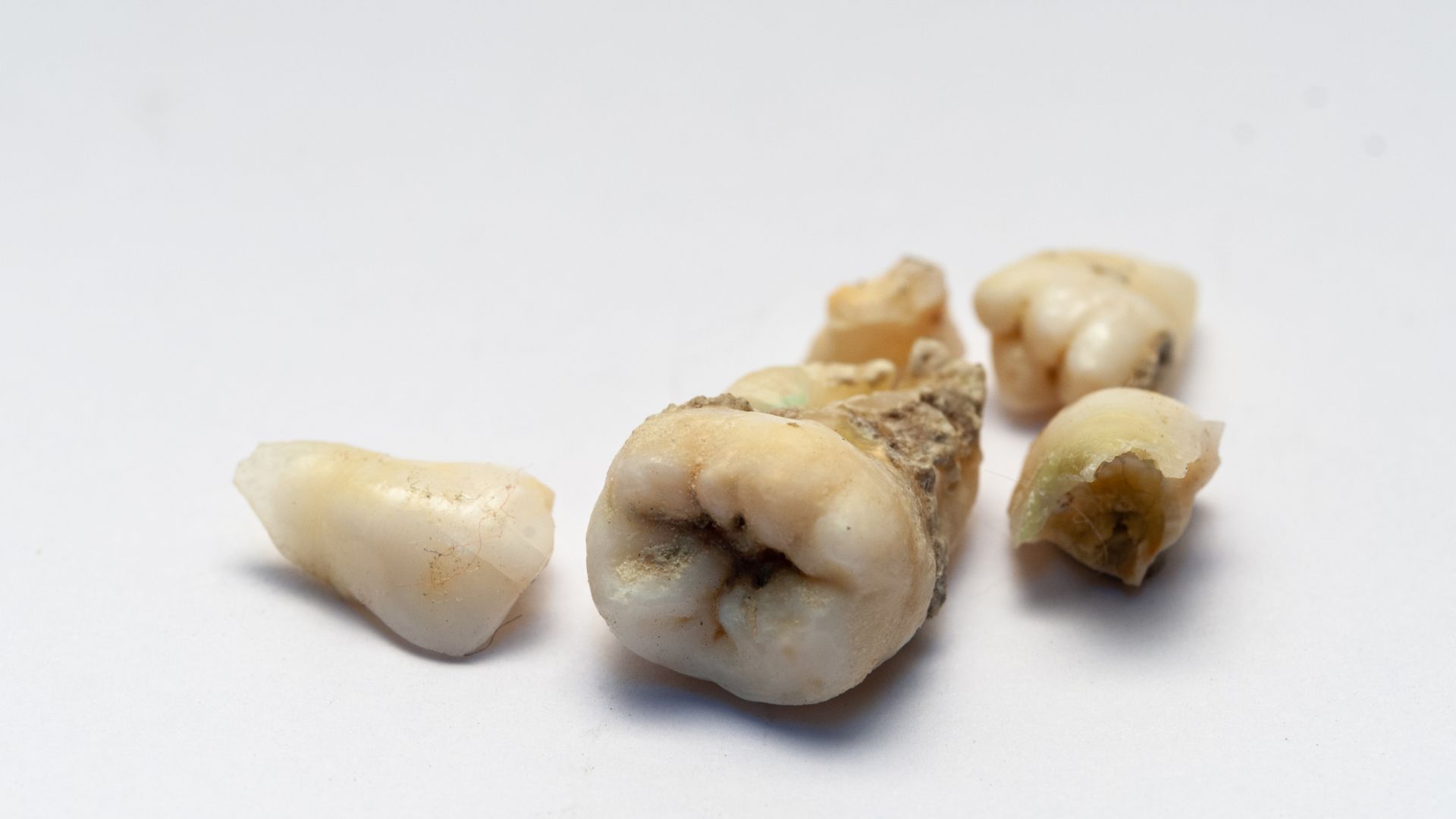 【痛くなってからでは遅い】むし歯を放置すると起こる5つの深刻なリスク|博多駅5分の歯医者が解説