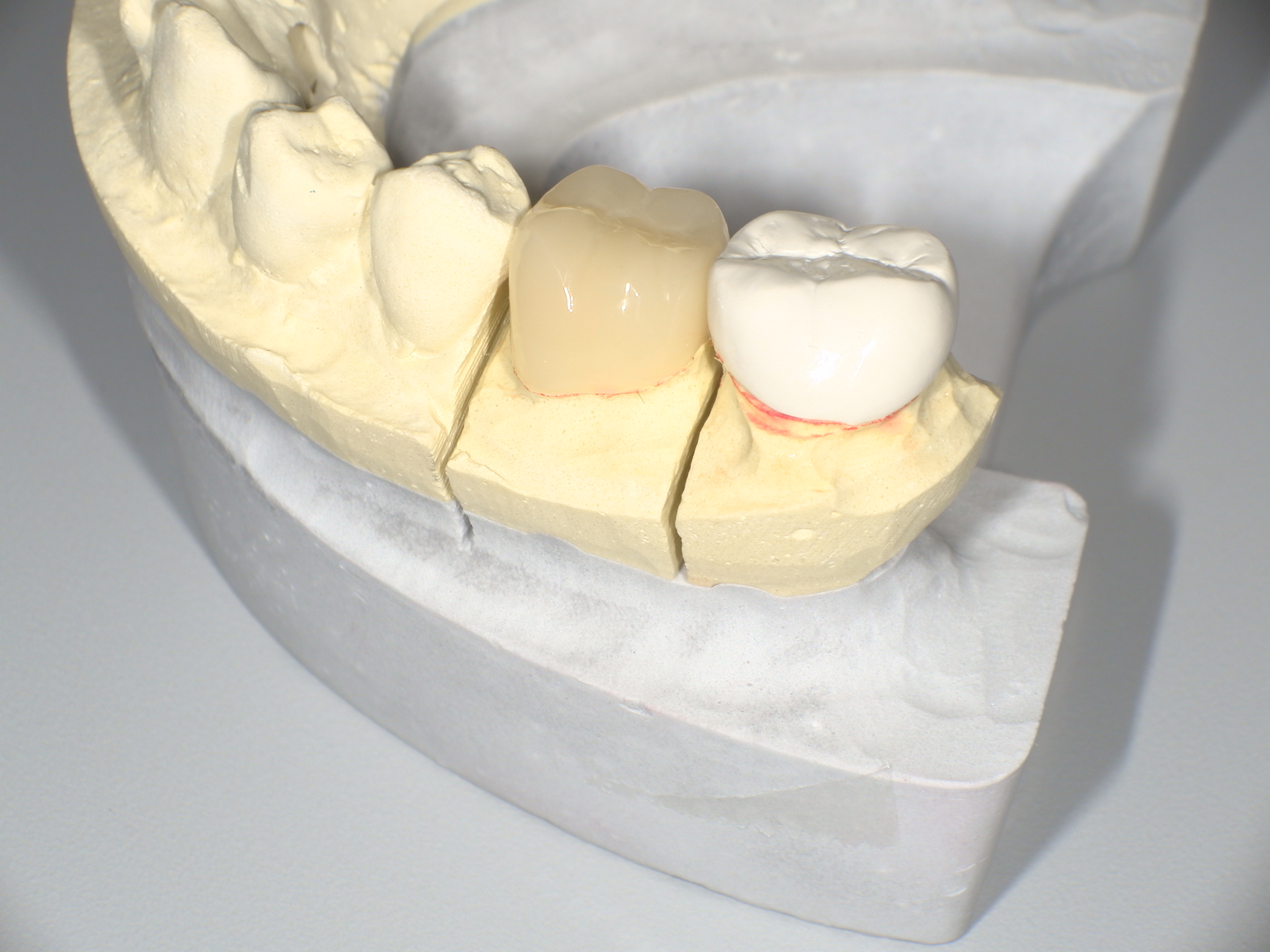 【最近よく聞くけど実際どう？】PEEK冠（ピーク冠）の特徴・メリットと注意点を歯科医が解説