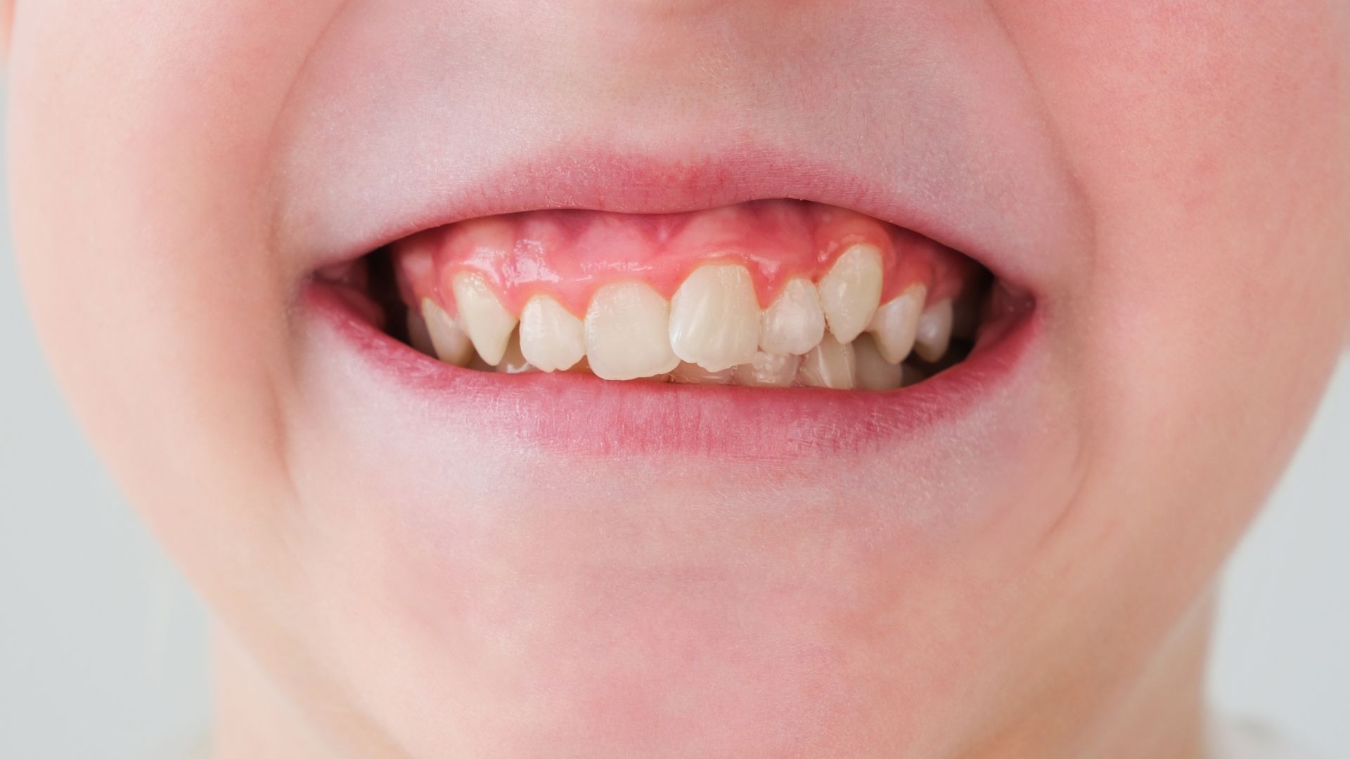 【前歯だけ整えたい方へ】部分矯正のメリットとは？全体矯正との違いも歯科医が解説｜博多駅5分の歯医者