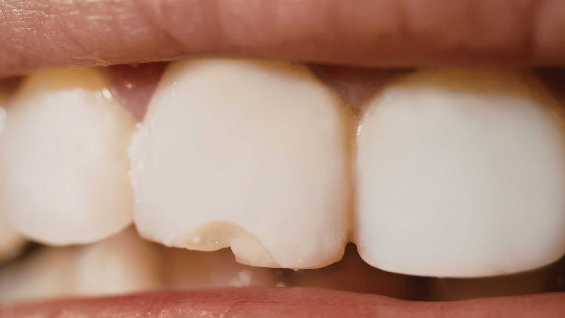 【放置は危険？】歯が欠けたときの正しい対処法｜すぐ歯医者に行くべきケースを歯科医が解説