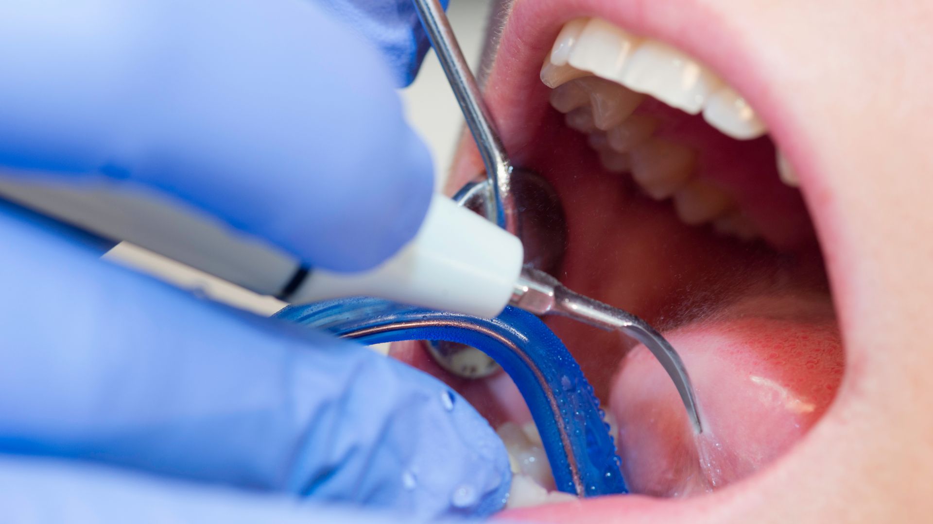 【歯石とは？】放置するとどうなる？原因・除去の必要性と方法を歯科医が解説