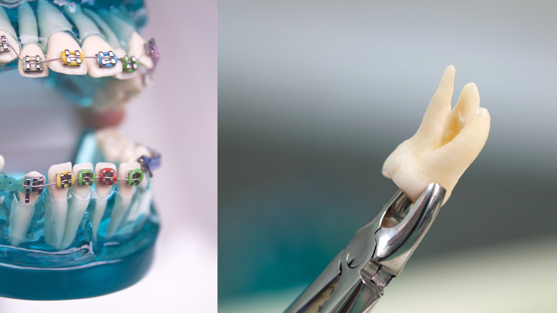 【矯正=抜歯は本当?】歯を抜くケース・抜かないケースを歯科医がわかりやすく解説