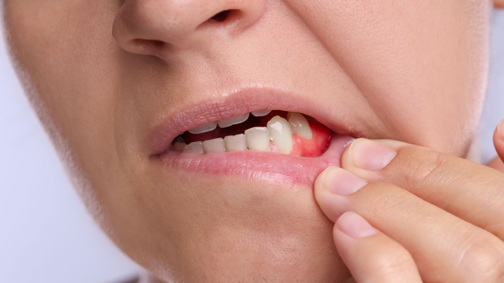 【歯茎が下がる原因と対処法】放置すると危険?歯肉退縮の治し方と予防法を解説