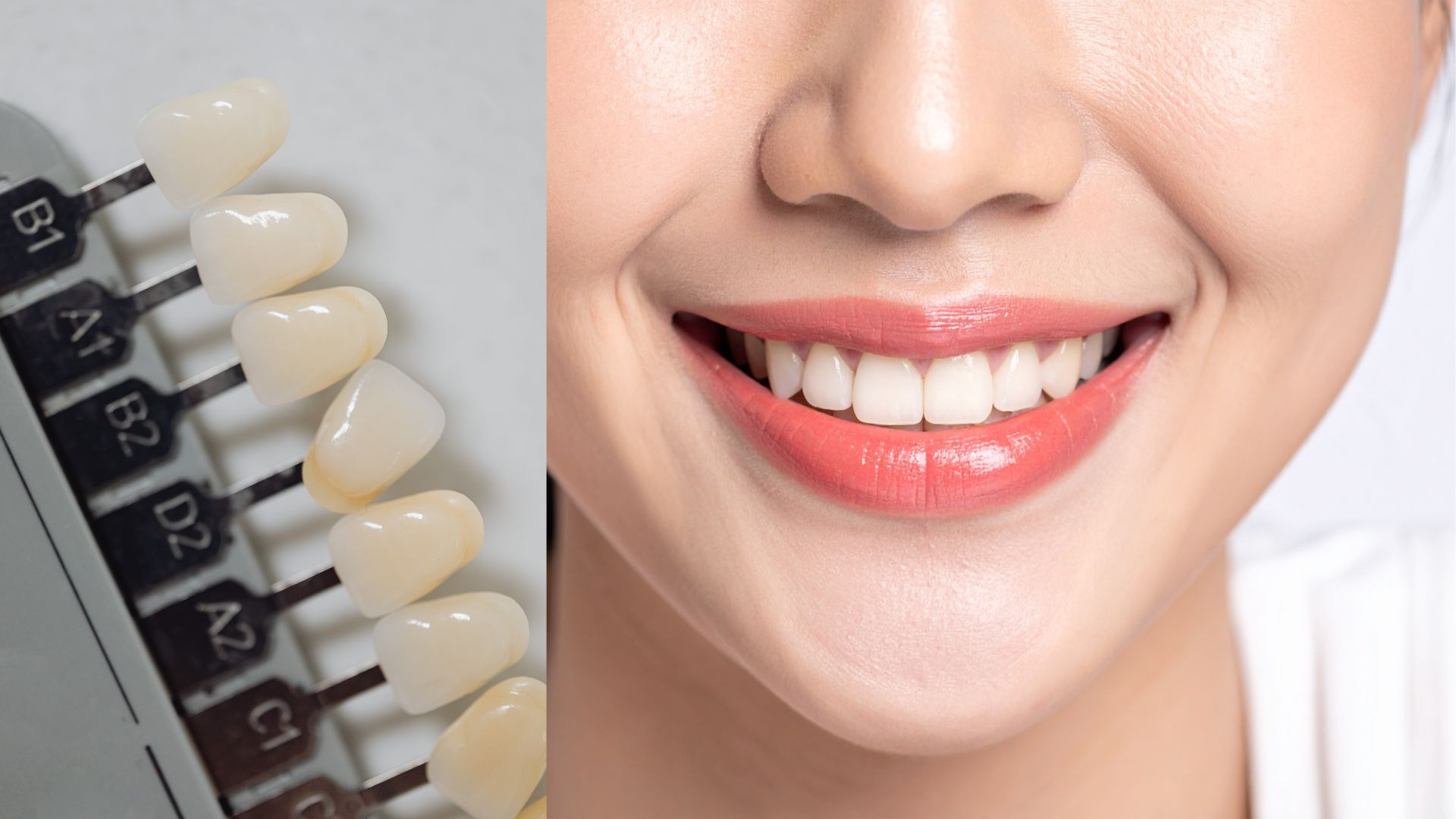 【そのまま使える？】ホームホワイトニングにマウスピース矯正のマウスピースは使えるのか歯科医が解説