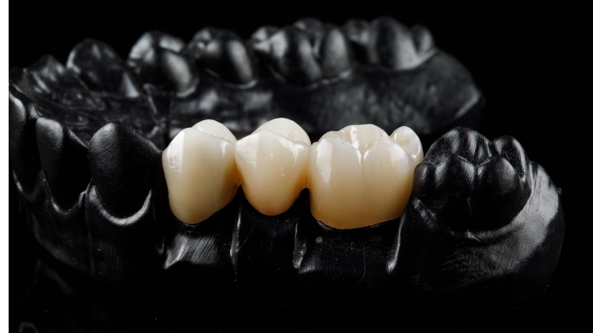 【同じじゃないの？】セラミックとジルコニアの違いとは｜呼び方が分かれた背景も歯科医が解説