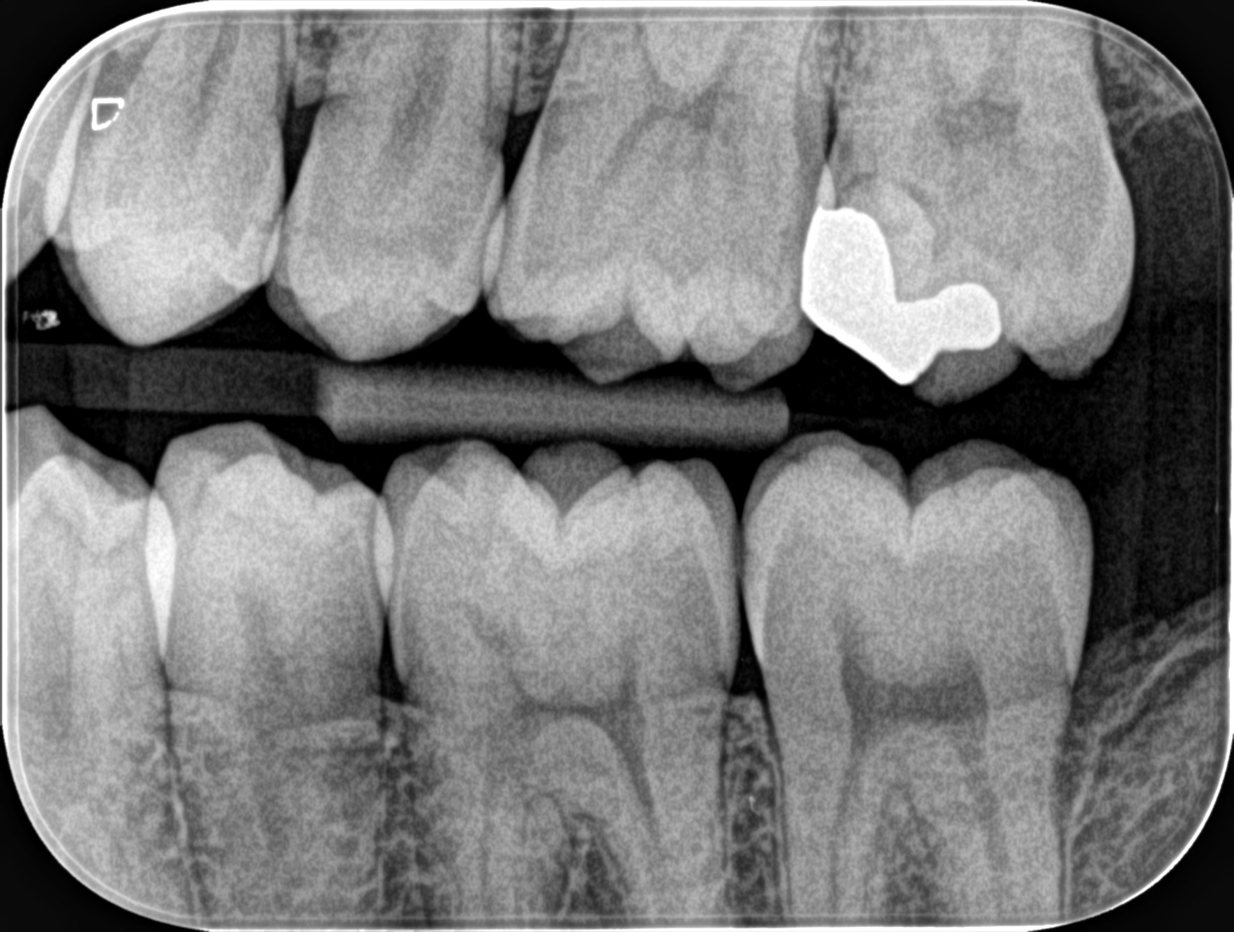 バイトウィングとは？むし歯発見に欠かせないレントゲン検査を歯科医が解説