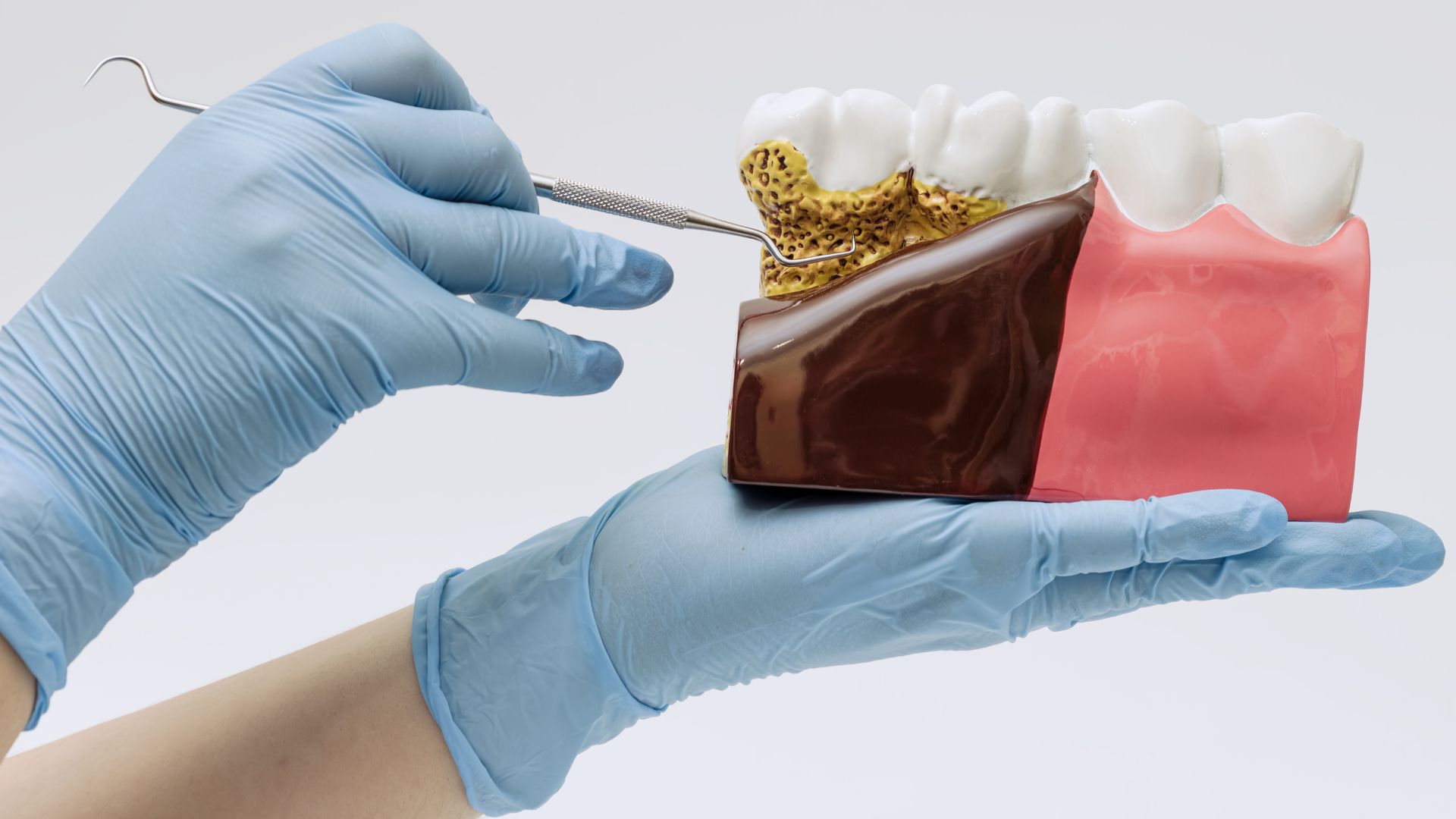 歯周ポケットってなに？放置するとどうなるの？