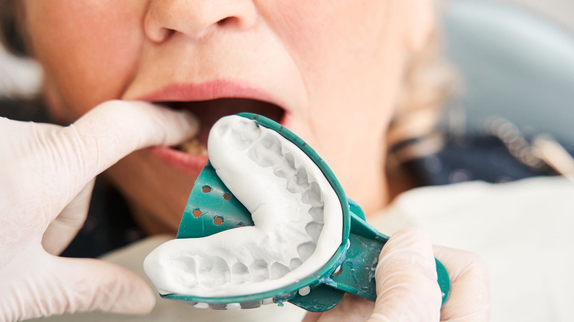 保険適用スタート！光学印象とは？白い被せ物（CAD/CAM冠）にも使える最新技術を解説