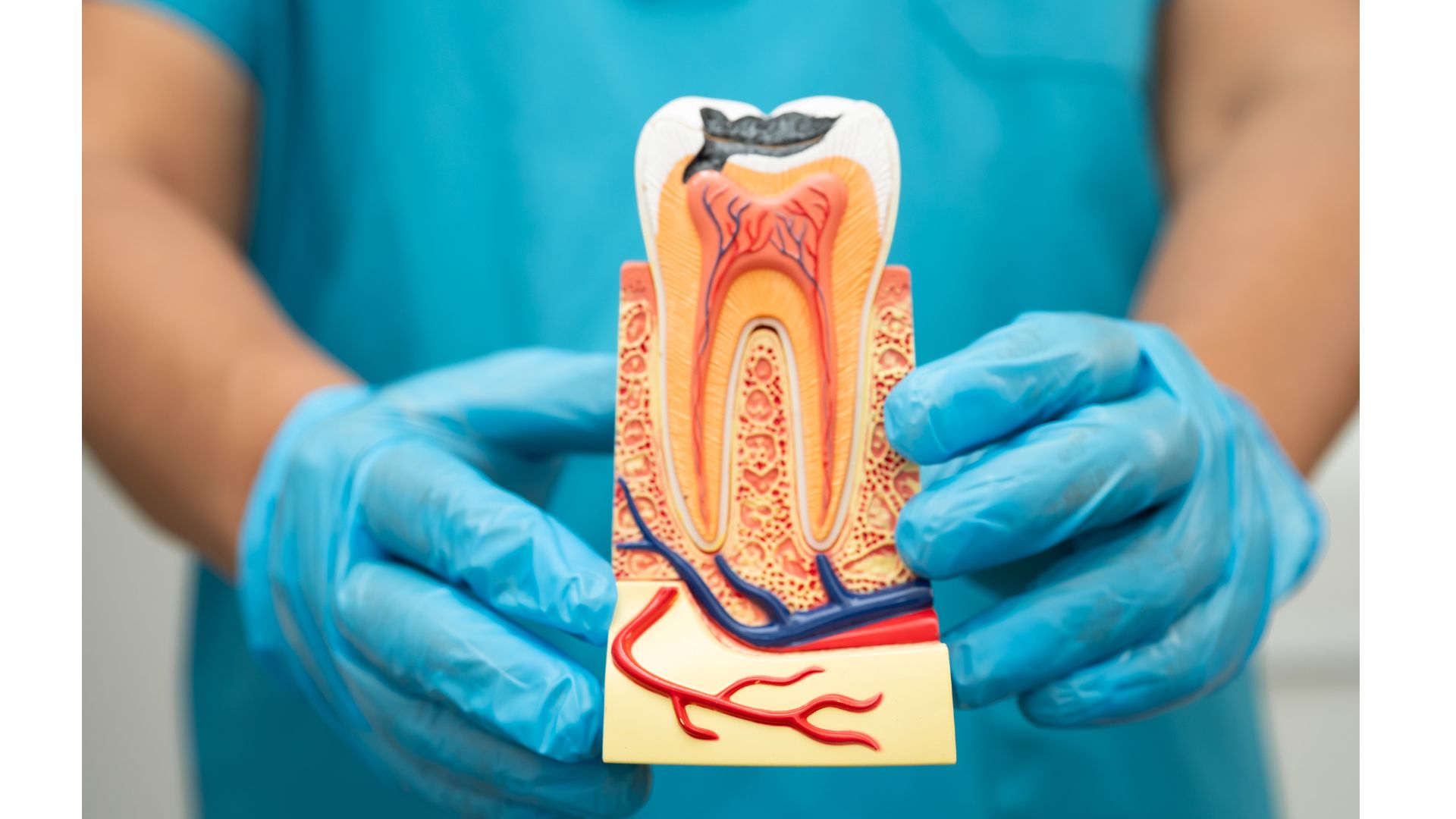 根管治療で差が出る？MTAセメントとは｜なぜ専門医は使うのか