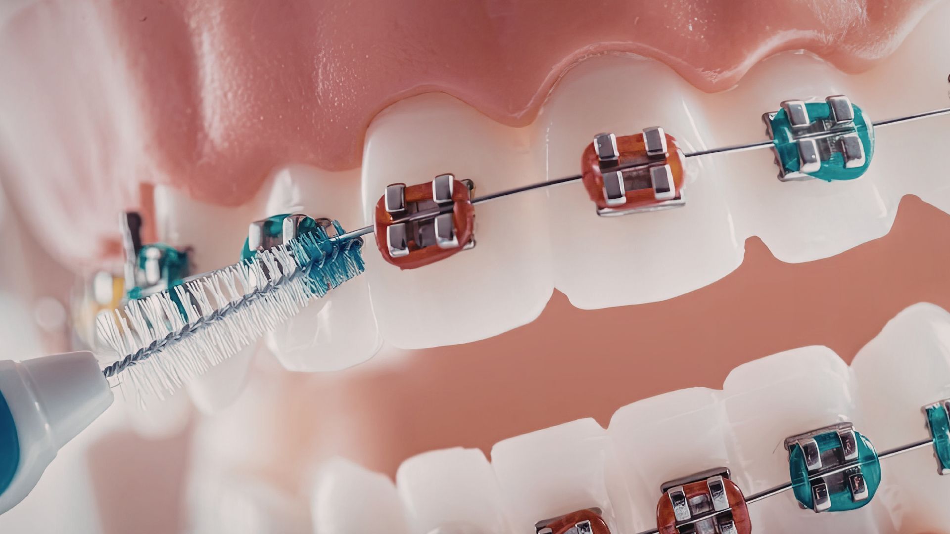 ワイヤー矯正とマウスピース矯正は「動かし方」がまったく違う