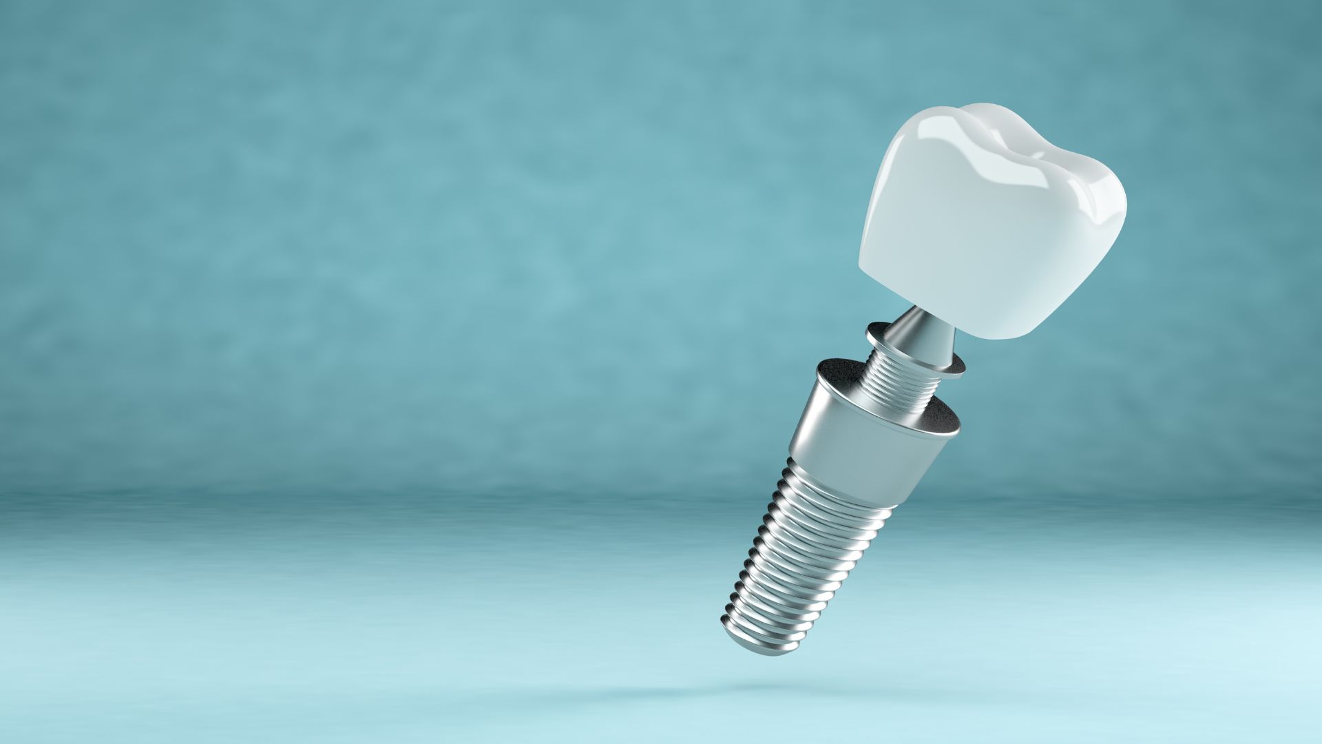 インプラントはどのくらい持つ？寿命と長持ちさせるポイントを解説