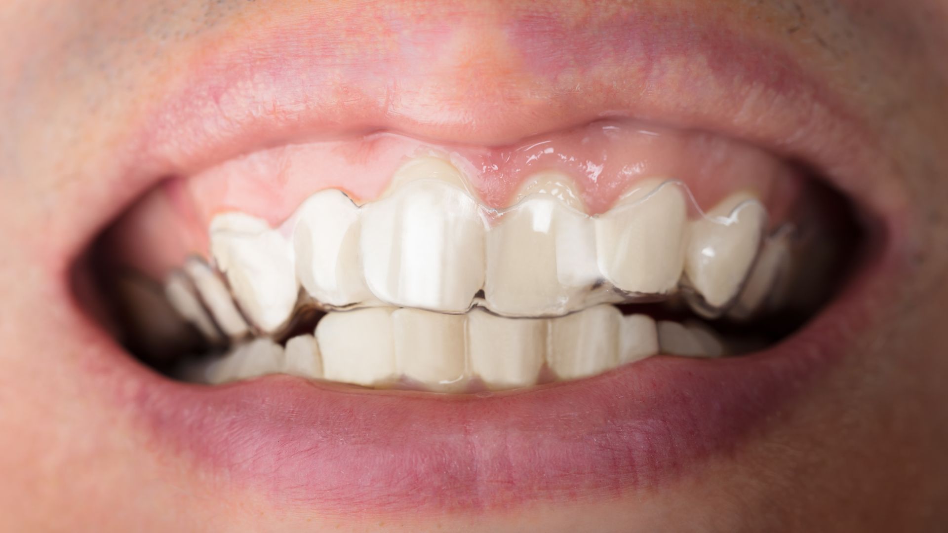 マウスピース矯正とワイヤー矯正の違い｜どっちが自分に合う？