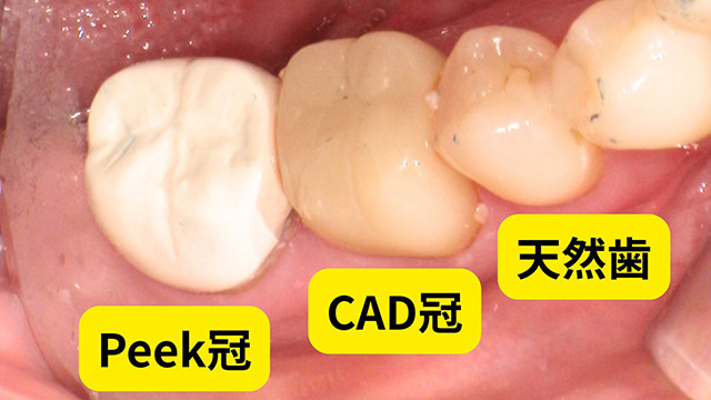 白い詰め物・被せ物