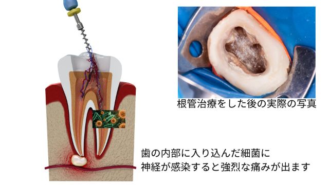 歯の内部に入り込んだ細菌に神経が感染すると強烈な痛みが出ます