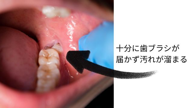 十分に歯ブラシが届かず汚れが溜まる