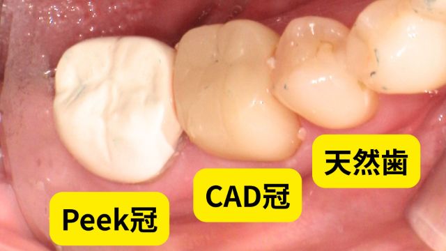 Peek冠・CAD冠・天然歯