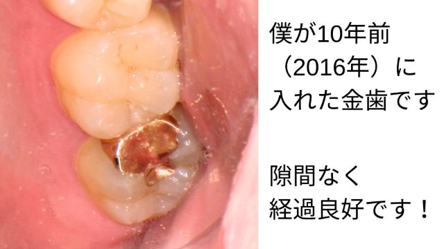 僕が10年前（2016年）に入れた金歯です。隙間なく経過良好です！