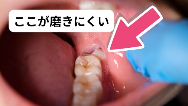 ここが磨きにくい