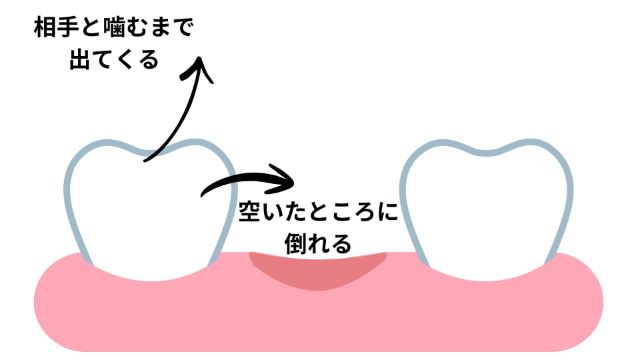 むし歯・歯の欠損の放置で起こる現象