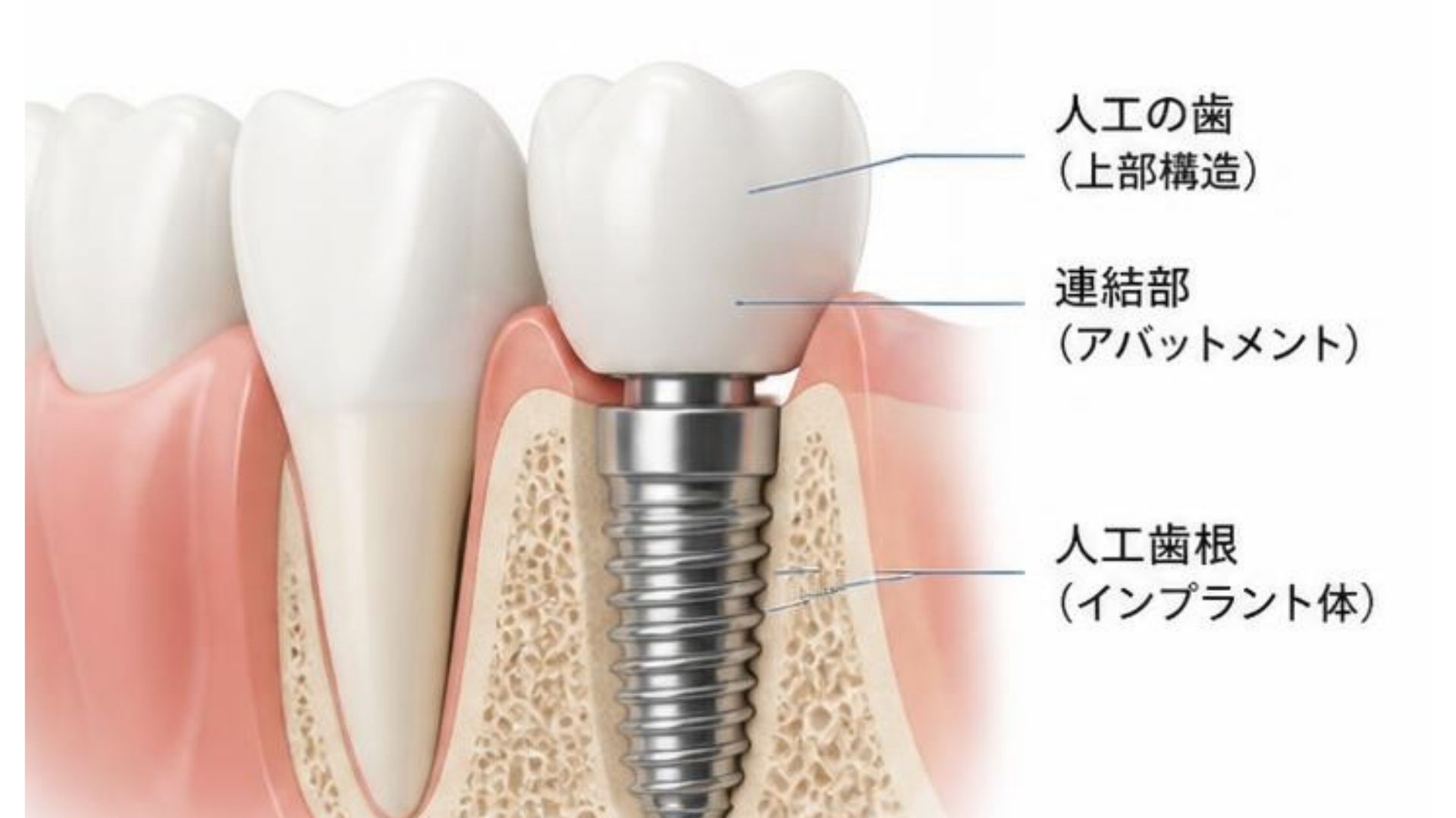 インプラントの周りから出血したら危険？受診した方がいいサインを歯科医師が解説